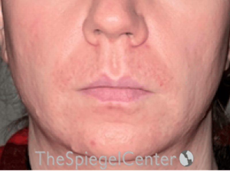 Lip Lift Before & After Gallery - Patient 247877 - Image 1