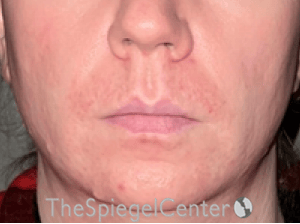 Lip Lift Before & After Gallery - Patient 247877 - Image 1