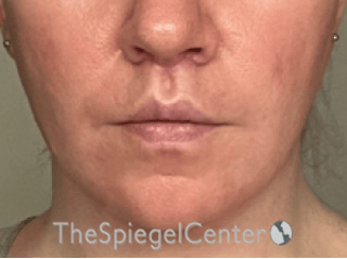 Lip Lift Before & After Gallery - Patient 247877 - Image 2
