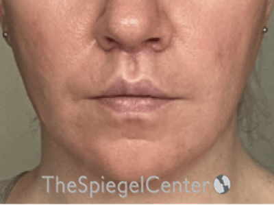 Lip Lift Before & After Gallery - Patient 247877 - Image 2