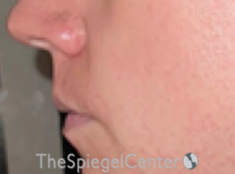 Lip Lift Before & After Gallery - Patient 247877 - Image 3