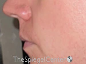 Lip Lift Before & After Gallery - Patient 247877 - Image 3