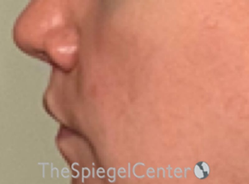 Lip Lift Before & After Gallery - Patient 247877 - Image 4