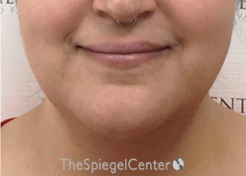 Lip Lift Before & After Gallery - Patient 286235 - Image 1