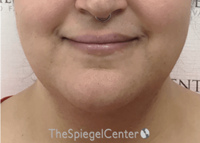 Lip Lift Before & After Gallery - Patient 286235 - Image 1