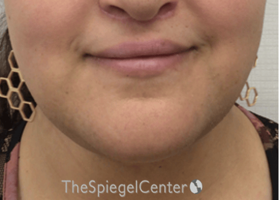 Lip Lift Before & After Gallery - Patient 286235 - Image 2