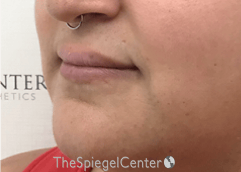 Lip Lift Before & After Gallery - Patient 286235 - Image 3