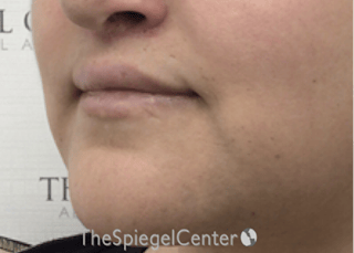 Lip Lift Before & After Gallery - Patient 286235 - Image 4