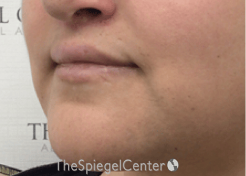 Lip Lift Before & After Gallery - Patient 286235 - Image 4