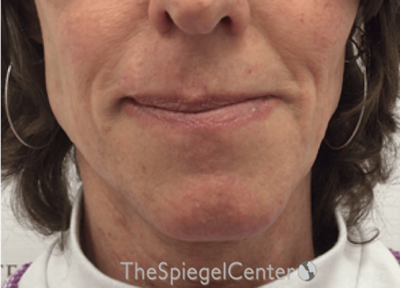 Lip Lift Before & After Gallery - Patient 257652 - Image 1