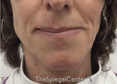 Lip Lift Before & After Gallery - Patient 257652 - Image 1