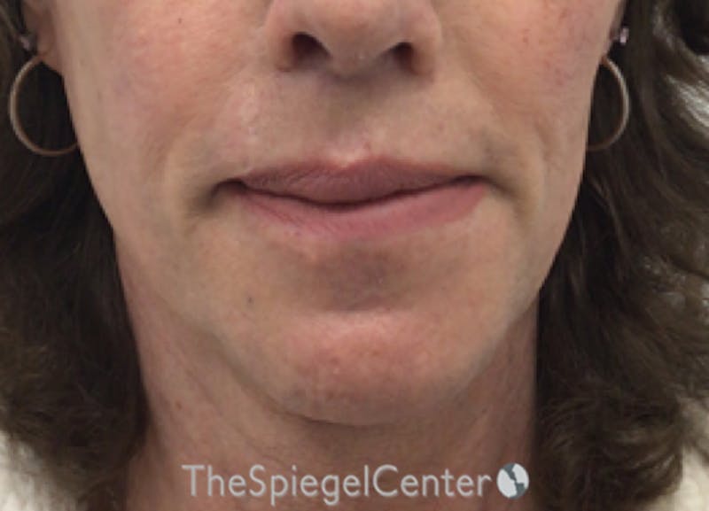 Lip Lift Before & After Gallery - Patient 257652 - Image 2