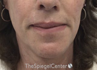 Lip Lift Before & After Gallery - Patient 257652 - Image 2