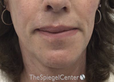 Lip Lift Before & After Gallery - Patient 257652 - Image 2