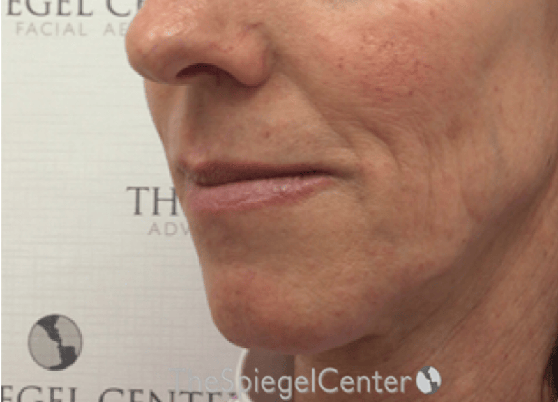 Lip Lift Before & After Gallery - Patient 257652 - Image 3