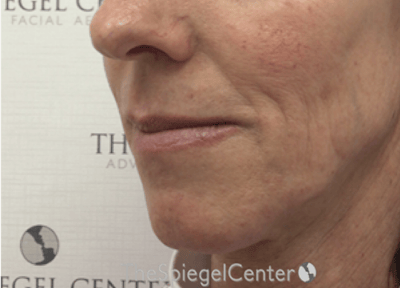 Lip Lift Before & After Gallery - Patient 257652 - Image 3