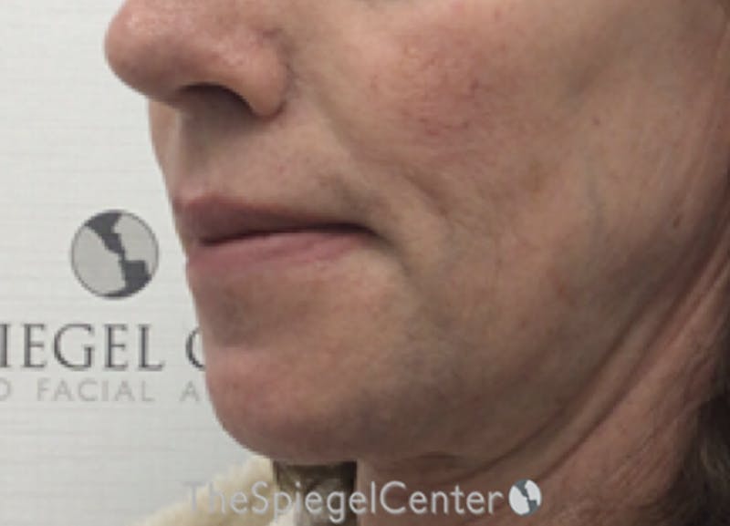 Lip Lift Before & After Gallery - Patient 257652 - Image 4