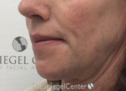 Lip Lift Before & After Gallery - Patient 257652 - Image 4