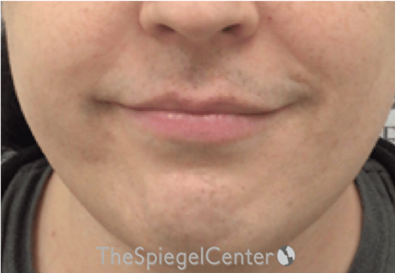 Lip Lift Before & After Gallery - Patient 895492 - Image 1
