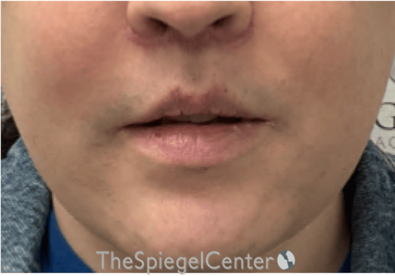 Lip Lift Before & After Gallery - Patient 895492 - Image 2