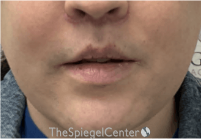 Lip Lift Before & After Gallery - Patient 895492 - Image 2