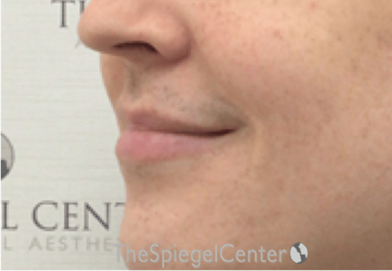 Lip Lift Before & After Gallery - Patient 895492 - Image 3