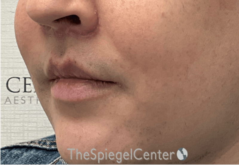 Lip Lift Before & After Gallery - Patient 895492 - Image 4