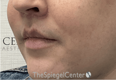 Lip Lift Before & After Gallery - Patient 895492 - Image 4
