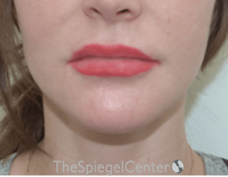 Lip Lift Before & After Gallery - Patient 304514 - Image 1