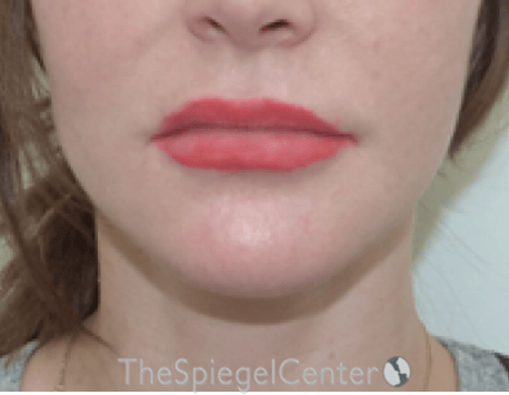 Lip Lift Before & After Gallery - Patient 304514 - Image 1