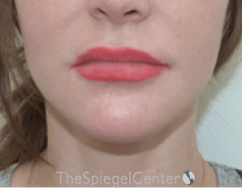 Lip Lift Before & After Gallery - Patient 304514 - Image 1