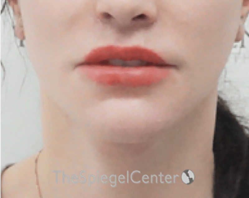 Lip Lift Before & After Gallery - Patient 304514 - Image 2