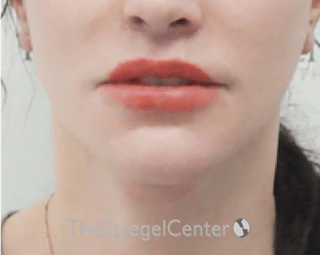 Lip Lift Before & After Gallery - Patient 304514 - Image 2