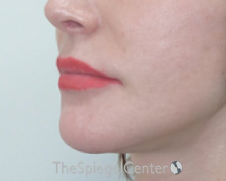 Lip Lift Before & After Gallery - Patient 304514 - Image 3