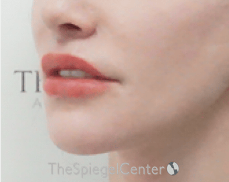 Lip Lift Before & After Gallery - Patient 304514 - Image 4