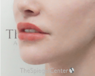 Lip Lift Before & After Gallery - Patient 304514 - Image 4