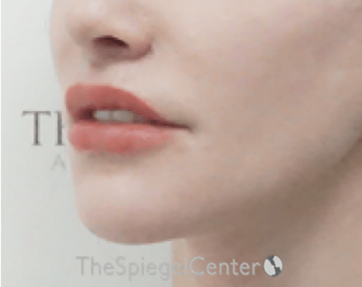 Lip Lift Before & After Gallery - Patient 304514 - Image 4