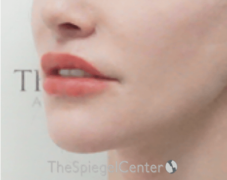 Lip Lift Before & After Gallery - Patient 304514 - Image 4