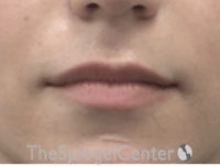 Lip Lift Before & After Gallery - Patient 226535 - Image 1