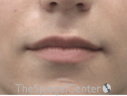 Lip Lift Before & After Gallery - Patient 226535 - Image 1