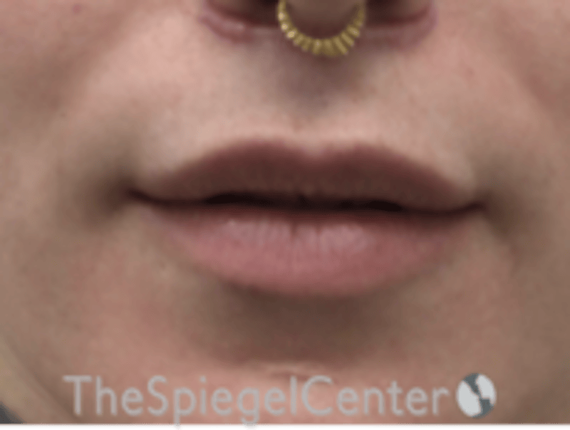 Lip Lift Before & After Gallery - Patient 226535 - Image 2