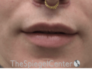 Lip Lift Before & After Gallery - Patient 226535 - Image 2