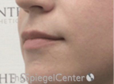 Lip Lift Before & After Gallery - Patient 226535 - Image 3
