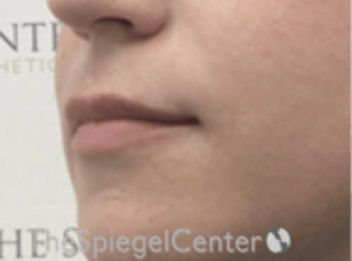 Lip Lift Before & After Gallery - Patient 226535 - Image 3
