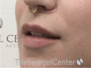 Lip Lift Before & After Gallery - Patient 226535 - Image 4