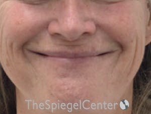 Lip Lift Before & After Gallery - Patient 323969 - Image 1