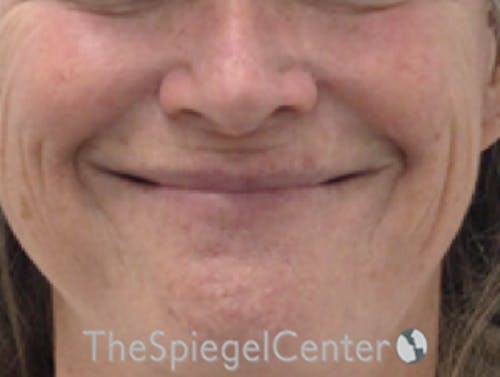 Lip Lift Before & After Gallery - Patient 323969 - Image 1