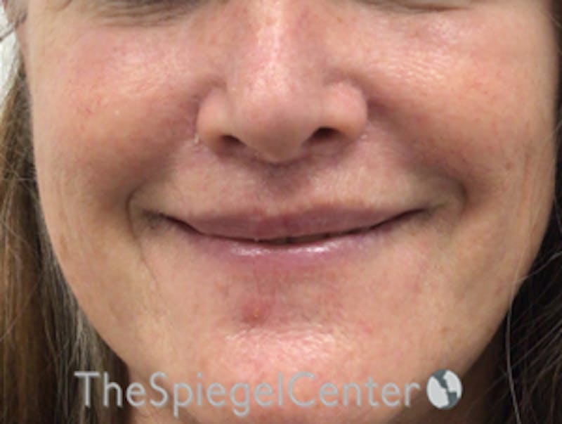 Lip Lift Before & After Gallery - Patient 323969 - Image 2