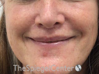 Lip Lift Before & After Gallery - Patient 323969 - Image 2