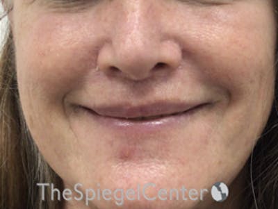 Lip Lift Before & After Gallery - Patient 323969 - Image 2